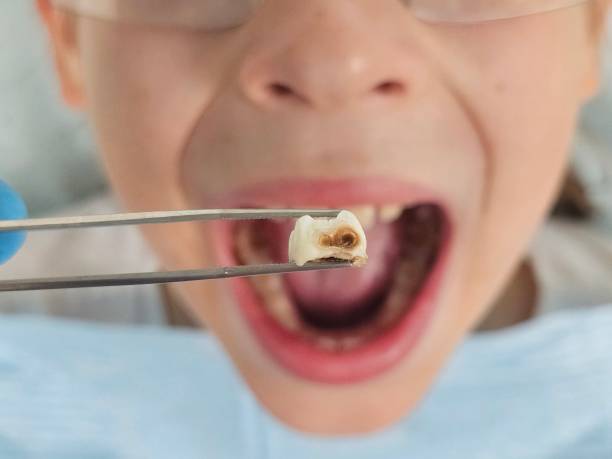 Best Emergency Dental Extractions in Fairbank, IA